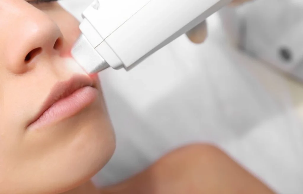 808nm diode laser facial hair removal treatment for upper lip and small facial areas