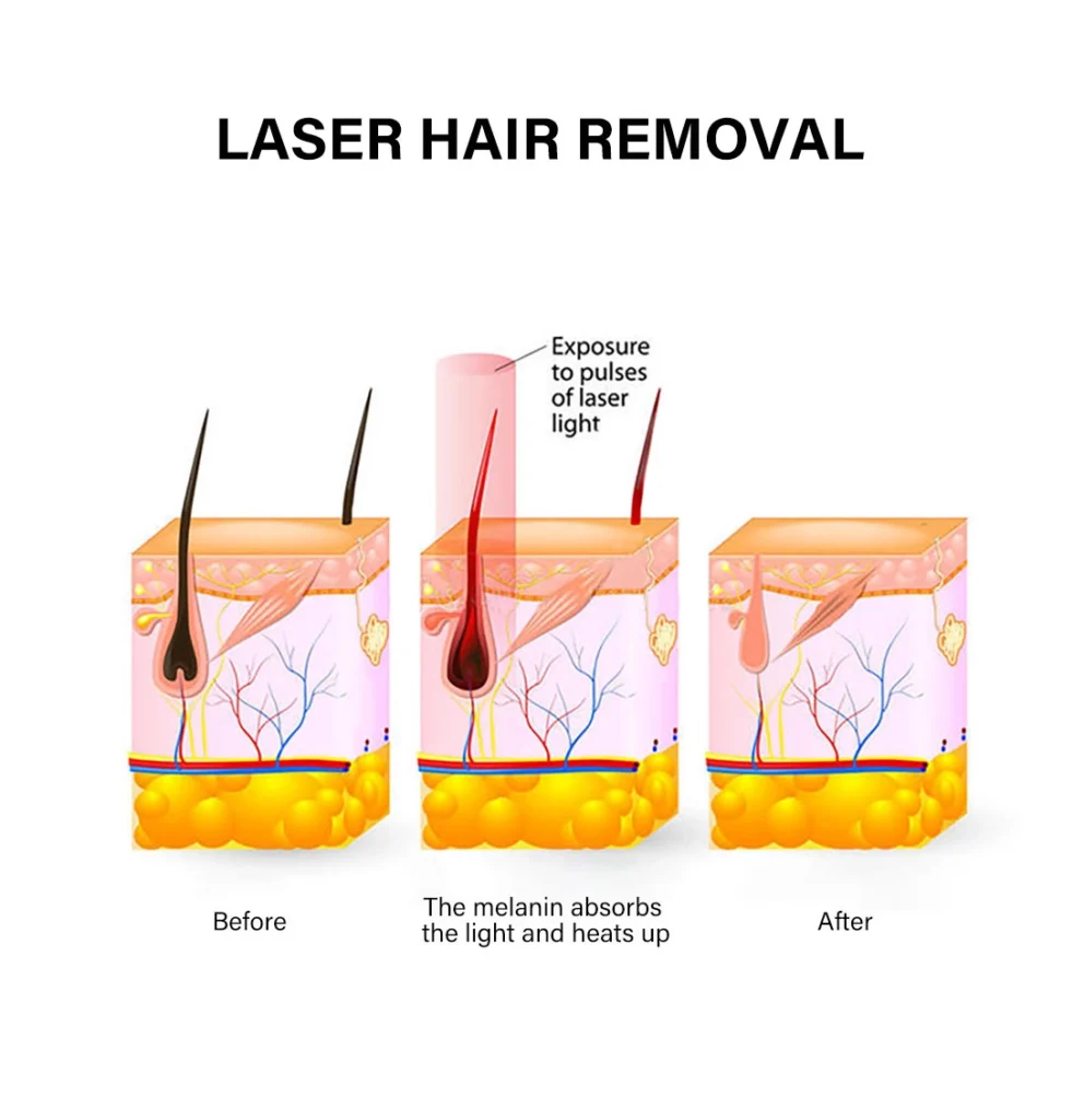 808nm diode laser hair removal working principle showing laser energy absorbed by melanin in the hair follicle